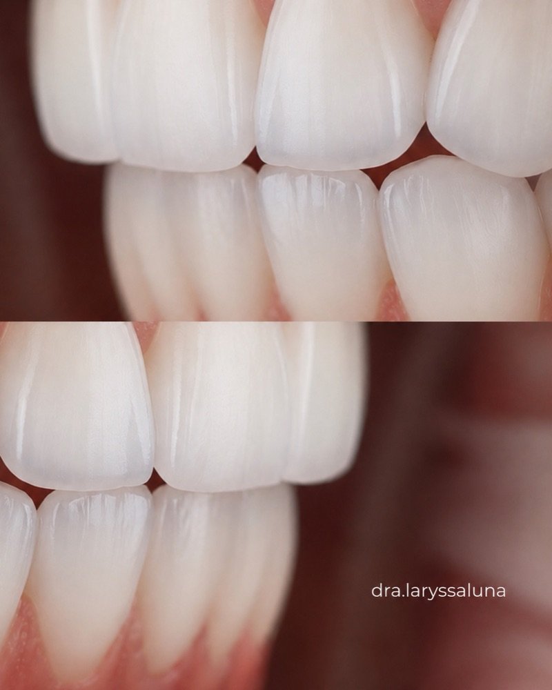 Sorriso natural em detalhe, resultado em resina