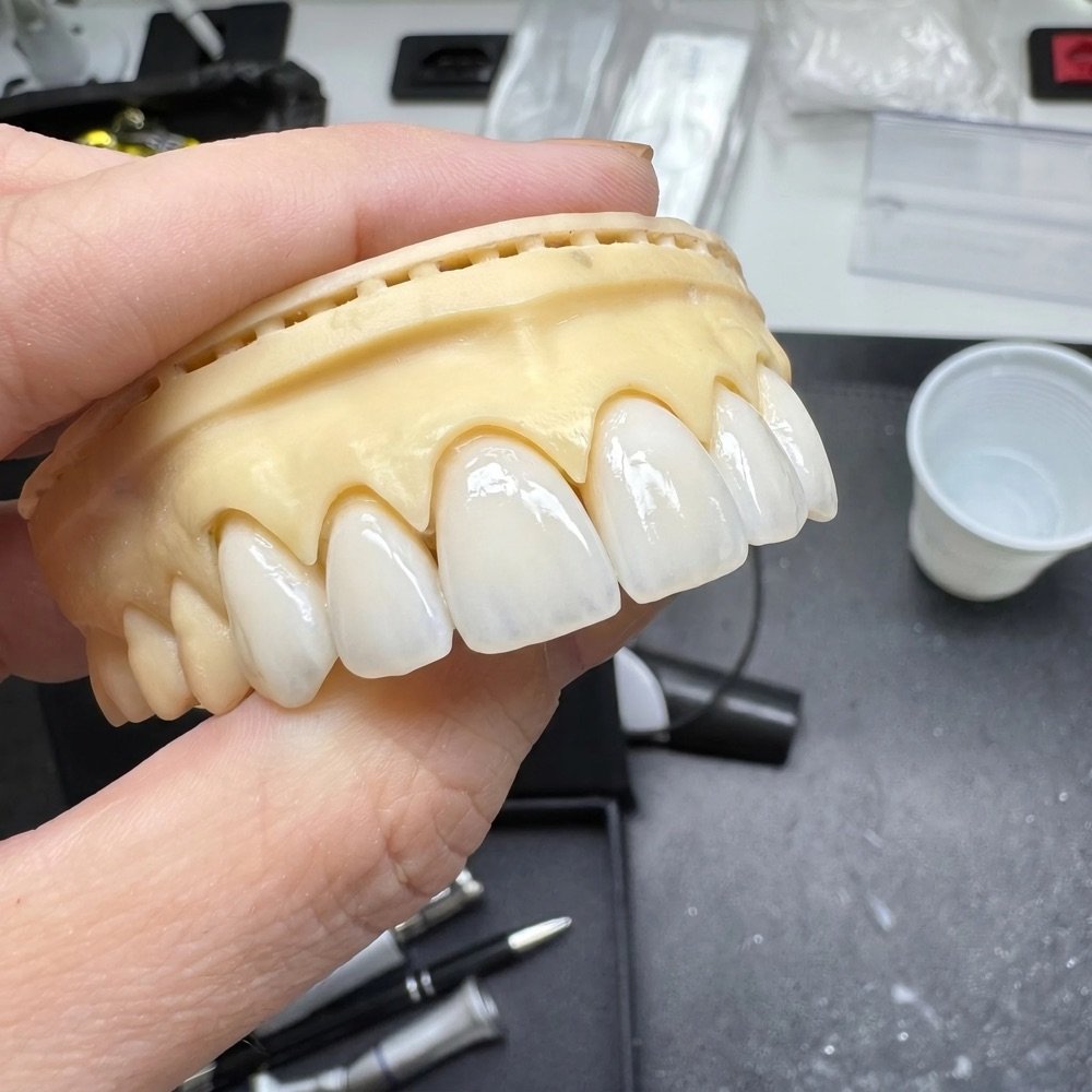 Desenho do sorriso: proporção e textura das lentes