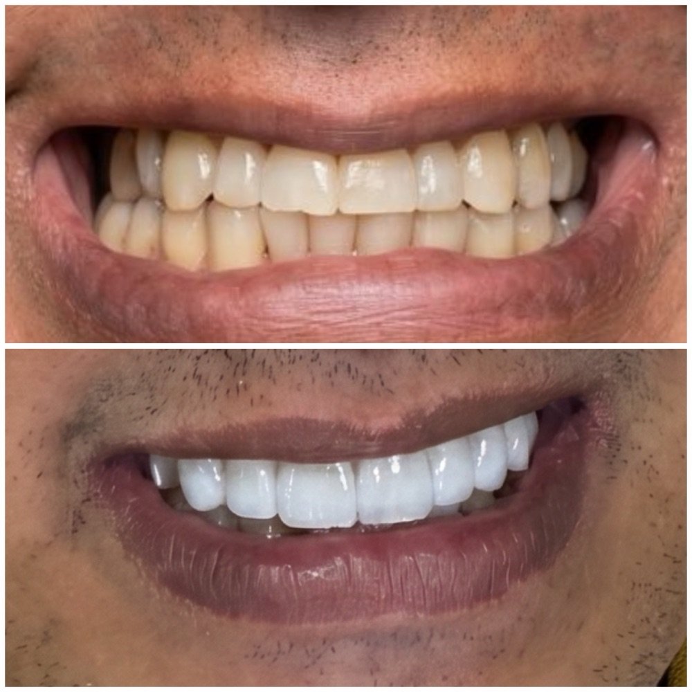 Caso real de reabilitação do sorriso, com autorização do paciente