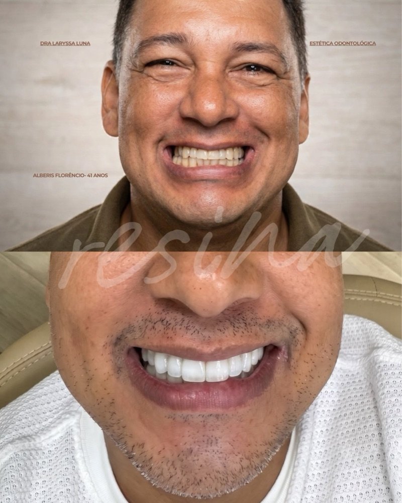 Caso real de sorriso em resina, com autorização do paciente